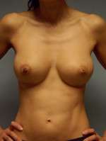 Breast Augmentation, Gel