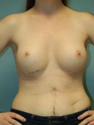 Breast Augmentation Revision Case 4643 Before Photo Breast Augmentation Revision