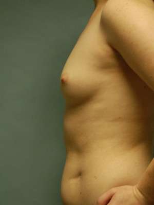 Breast Augmentation Revision Case 4643 Before Photo Breast Augmentation Revision