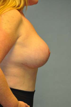 Breast Augmentation Revision Case 4672 After Photo Breast Augmentation Revision