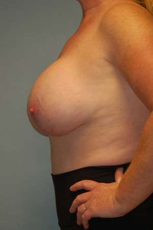 Breast Augmentation Revision Case 4672 Before Photo Breast Augmentation Revision