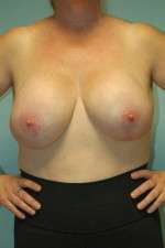 Breast Augmentation Revision