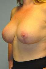 Breast Augmentation Revision