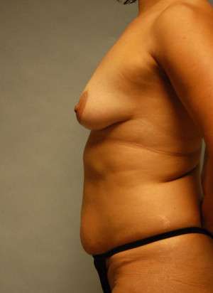 Ideal Structured Saline