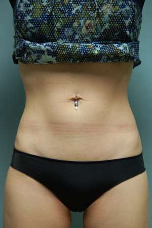 SculpSure™ Fat Removal Case 4619 After Photo SculpSure™ Fat Removal