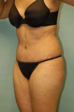 Abdominoplasty