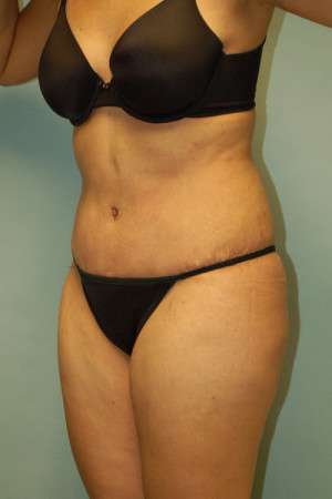 Abdominoplasty