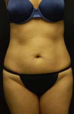 Abdominoplasty