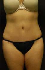 Abdominoplasty