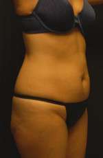 Abdominoplasty