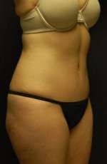 Abdominoplasty