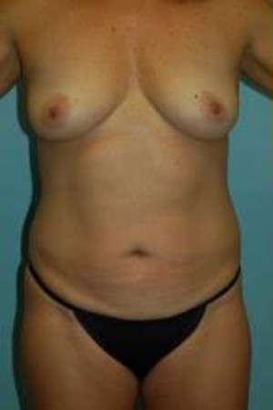 Ideal Structured Saline