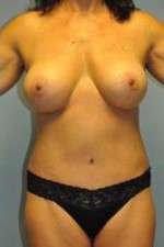 Ideal Structured Saline