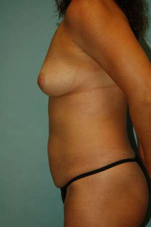 Ideal Structured Saline