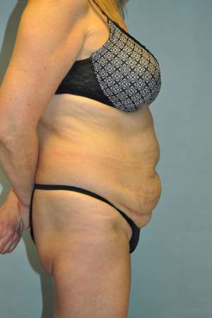 Abdominoplasty Case 4760 Before Photo Abdominoplasty