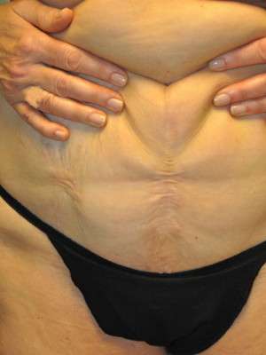 Abdominoplasty Case 4760 Before Photo Abdominoplasty