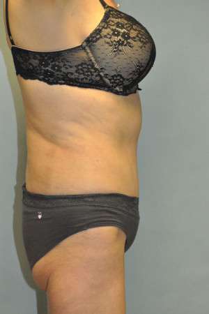 Abdominoplasty Case 4760 After Photo Abdominoplasty
