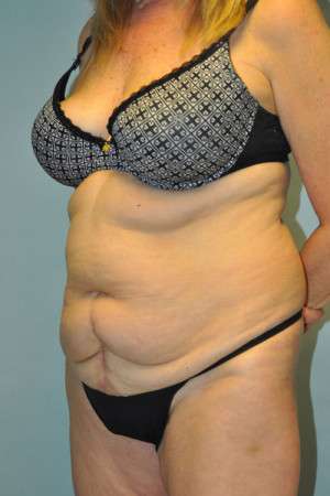 Abdominoplasty Case 4760 Before Photo Abdominoplasty