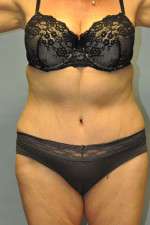 Abdominoplasty