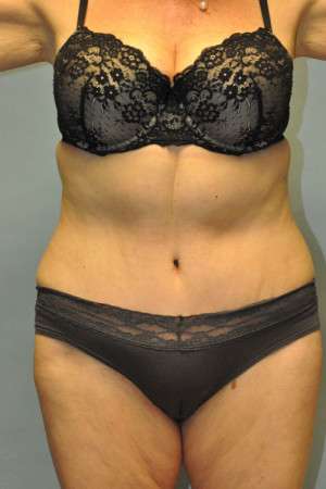 Abdominoplasty Case 4760 After Photo Abdominoplasty