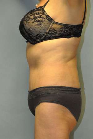 Abdominoplasty Case 4760 After Photo Abdominoplasty