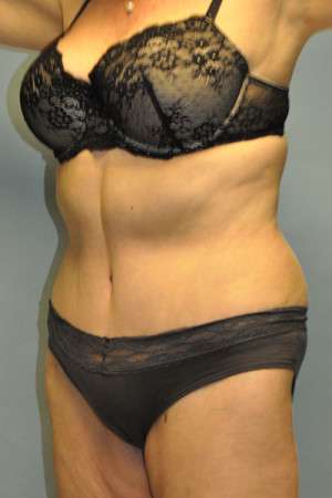 Abdominoplasty Case 4760 After Photo Abdominoplasty
