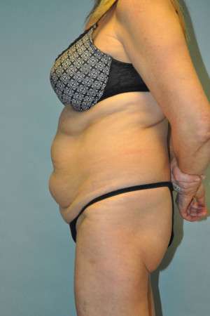 Abdominoplasty Case 4760 Before Photo Abdominoplasty