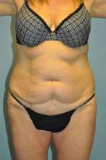 Abdominoplasty