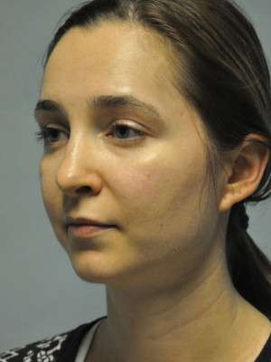 Nose Case 4775 After Photo Nose