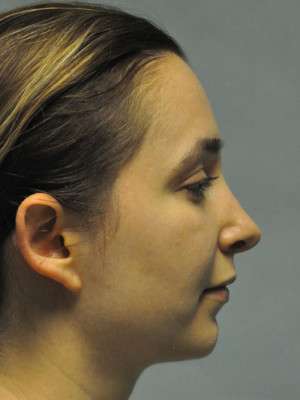 Nose Case 4775 After Photo Nose