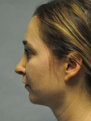 Nose Case 4775 After Photo Nose