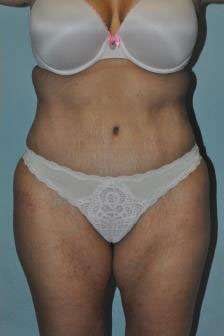 Abdominoplasty Case 4867 After Photo Abdominoplasty
