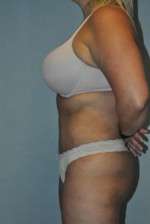 Abdominoplasty