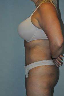 Abdominoplasty Case 4867 After Photo Abdominoplasty