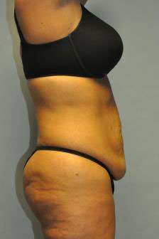 Abdominoplasty Case 4867 Before Photo Abdominoplasty