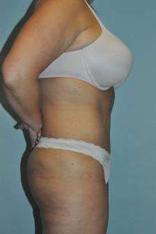 Abdominoplasty Case 4867 After Photo Abdominoplasty