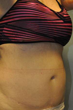 SculpSure™ Fat Removal Case 4896 After Photo SculpSure™ Fat Removal