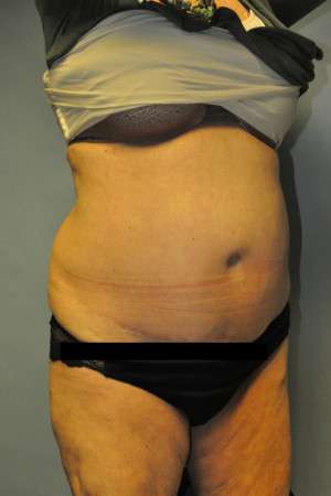 SculpSure™ Fat Removal Case 4896 Before Photo SculpSure™ Fat Removal