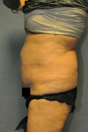 SculpSure™ Fat Removal Case 4896 Before Photo SculpSure™ Fat Removal