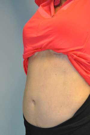 SculpSure™ Fat Removal Case 4896 After Photo SculpSure™ Fat Removal