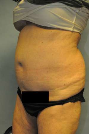 SculpSure™ Fat Removal Case 4896 Before Photo SculpSure™ Fat Removal