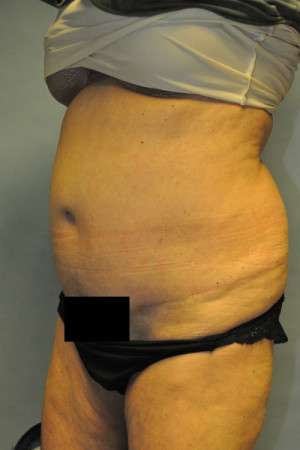 SculpSure™ Fat Removal Case 4896 Before Photo SculpSure™ Fat Removal