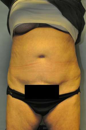SculpSure™ Fat Removal Case 4896 Before Photo SculpSure™ Fat Removal