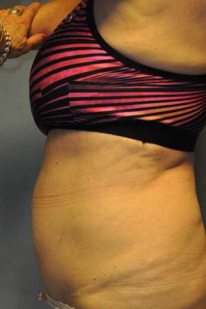 SculpSure™ Fat Removal Case 4896 After Photo SculpSure™ Fat Removal