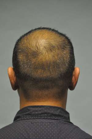 Otoplasty-Ear pinning