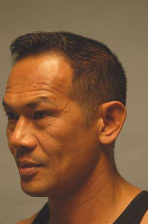 Otoplasty-Ear pinning