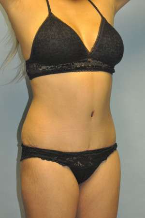 Abdominoplasty Case 4998 After Photo Abdominoplasty