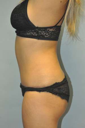 Abdominoplasty Case 4998 After Photo Abdominoplasty