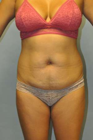 Abdominoplasty Case 4998 Before Photo Abdominoplasty
