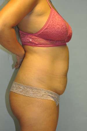 Abdominoplasty Case 4998 Before Photo Abdominoplasty